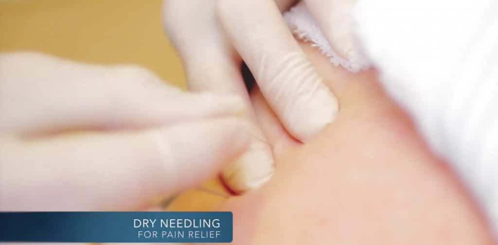 dry needling at APC Physio Cork and fermoy