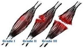 graphic showing grade 1-3 tears of the calf muscle
