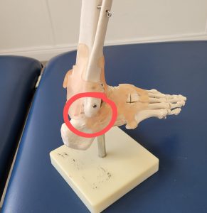 ankle model with heel injury marked