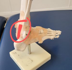 ankle model with injury area marked